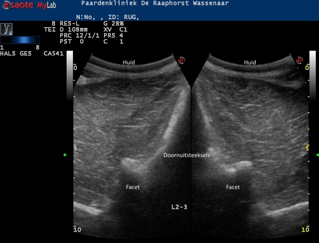 Echografische beeld van normale facetgewricht van de lendenwervels