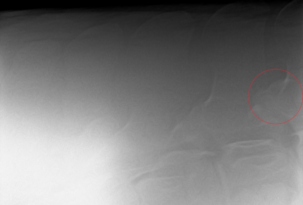 Het omcirkelde facetgewricht vertoont botnieuwvorming ten gevolge van artrose