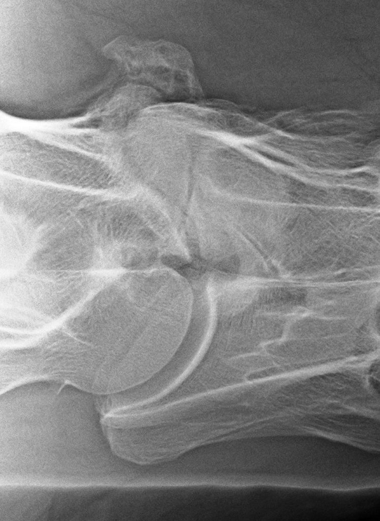 Breuk in het facetgewricht