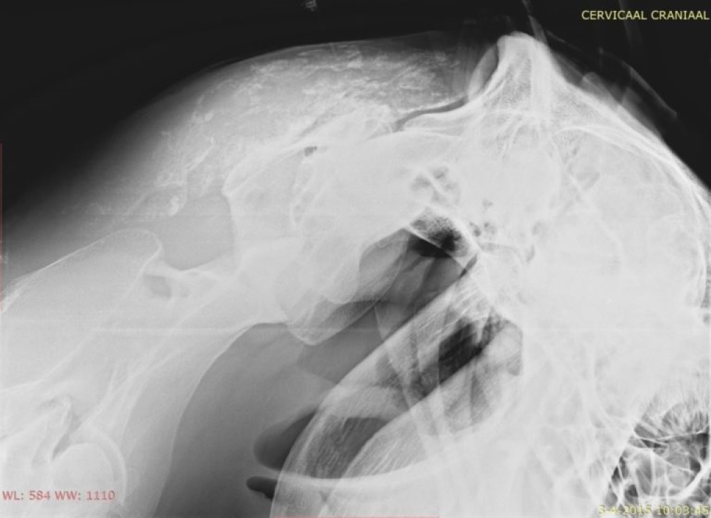 Overvulling en verkalkingen van de slijmbeurs van de nekband