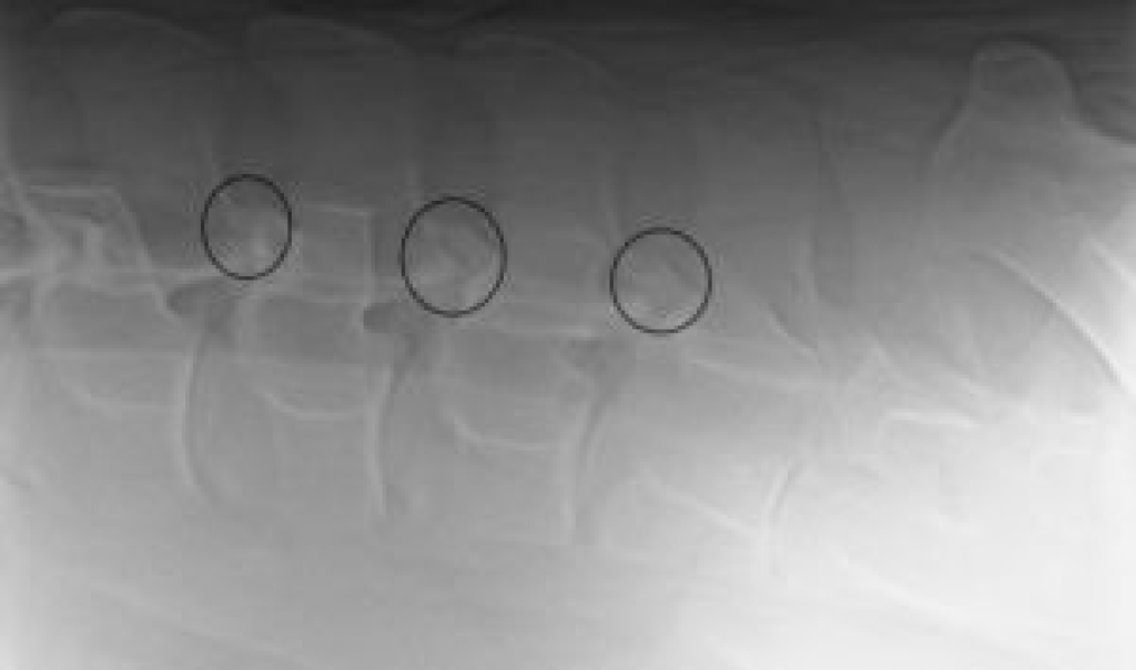 Röntgenopname van de facetgewrichten van de lendenen