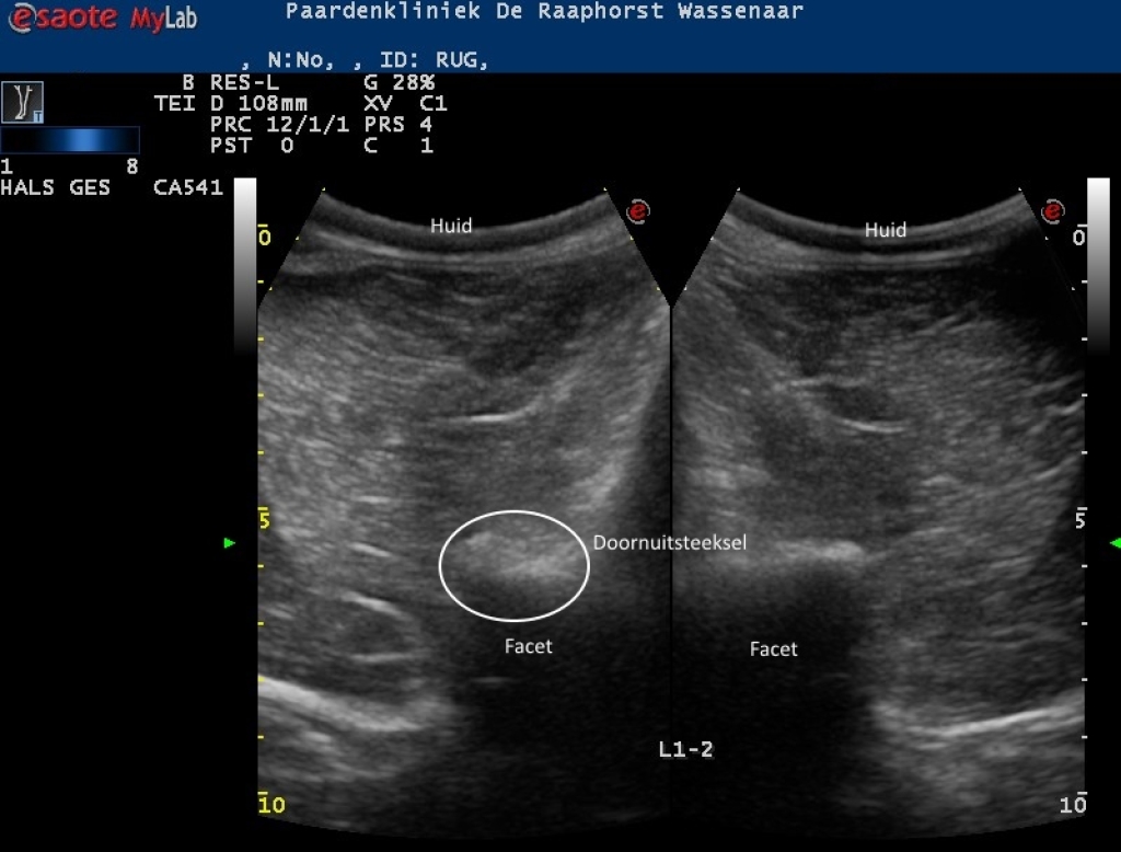 Echobeeld van artrose van een facetgewricht in het lendengebied